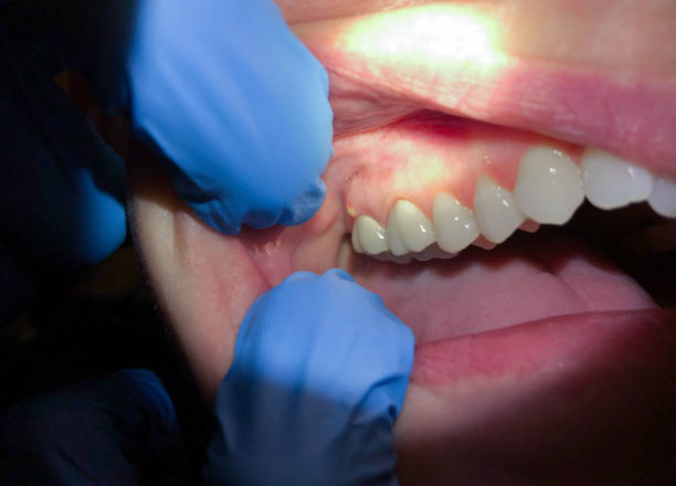 Best Dentist for Tooth Abscess  in Montz, LA