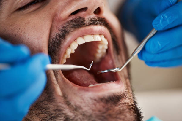 Emergency Dental Filling Replacement in LA