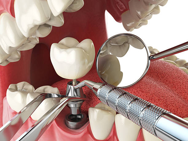 Best Dentist for Tooth Abscess  in Montz, LA